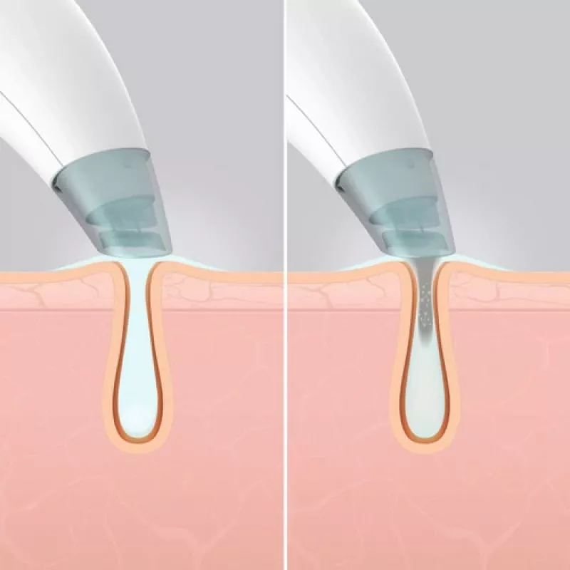 HoMedics FAC-HY100 ihonhoitolaite hydradermabrasio-puhdistin läpinäkyvä, valkoinen